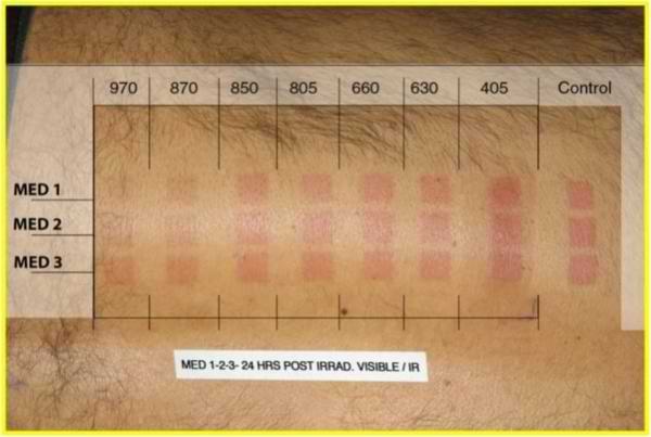 Rood Licht Therapie en Vitamine D