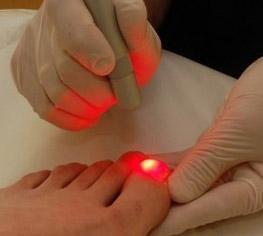 Red light is used to treat nail fungus
